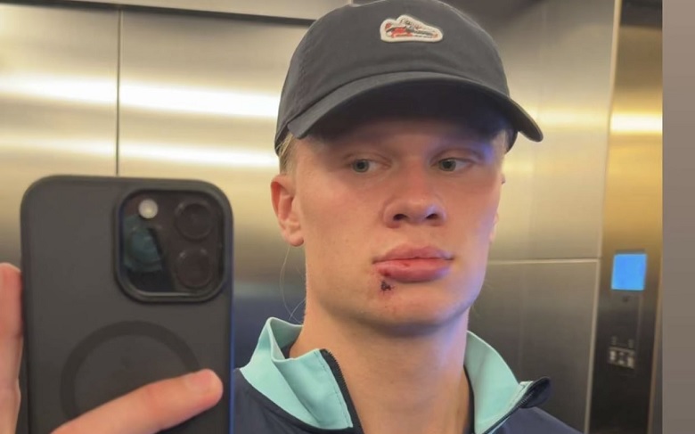 Erling Haaland với vết thương ở môi sau tai nạn hy hữu, nhưng chấn thương không ảnh hưởng đến khả năng thi đấu của anh cùng ĐT Na Uy